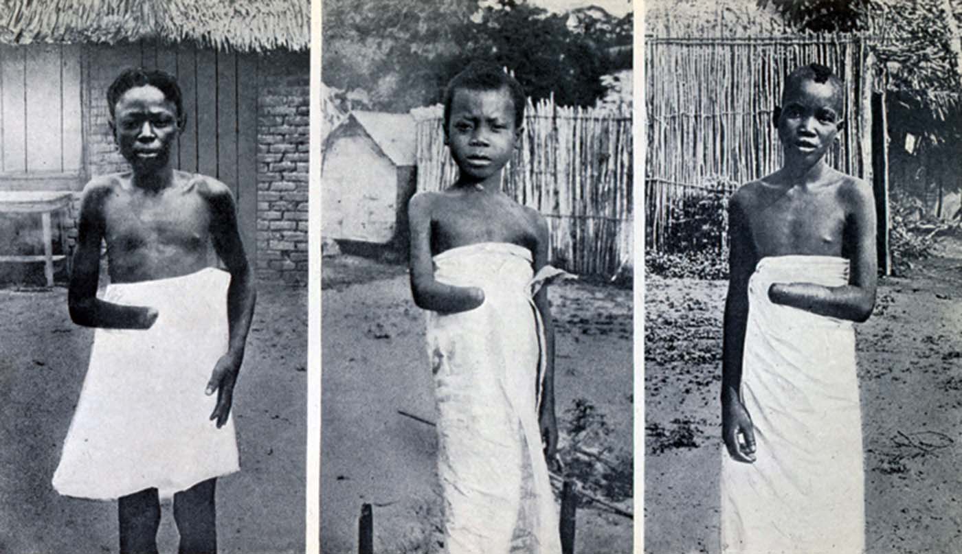 Le père regarde la main et du pied de son mandat de cinq ans, coupé comme une punition pour ne pas avoir à faire quotidiennement en caoutchouc quota, Congo Belge, 1904