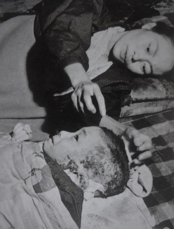 Une habitante d'Hiroshima et de son fils, souffrant de la bombe atomique